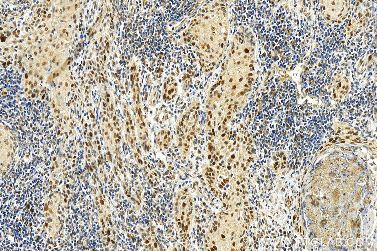 IHC staining of human skin cancer using 66870-1-Ig (same clone as 66870-1-PBS)