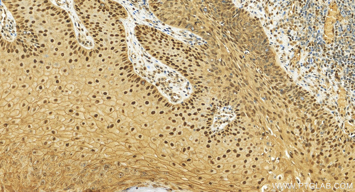 IHC staining of human brown disease using 28050-1-AP