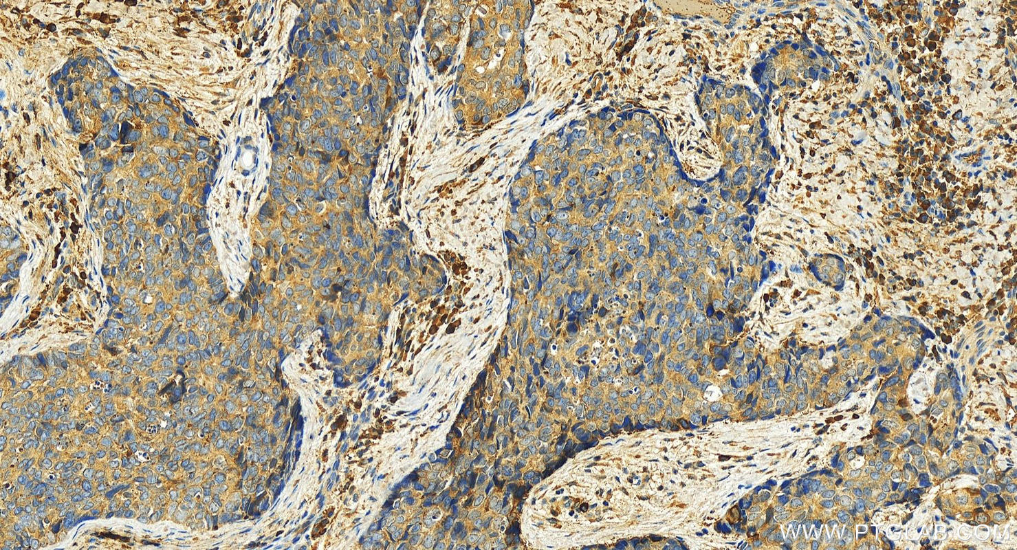 IHC staining of human bowen disease using 12463-1-AP