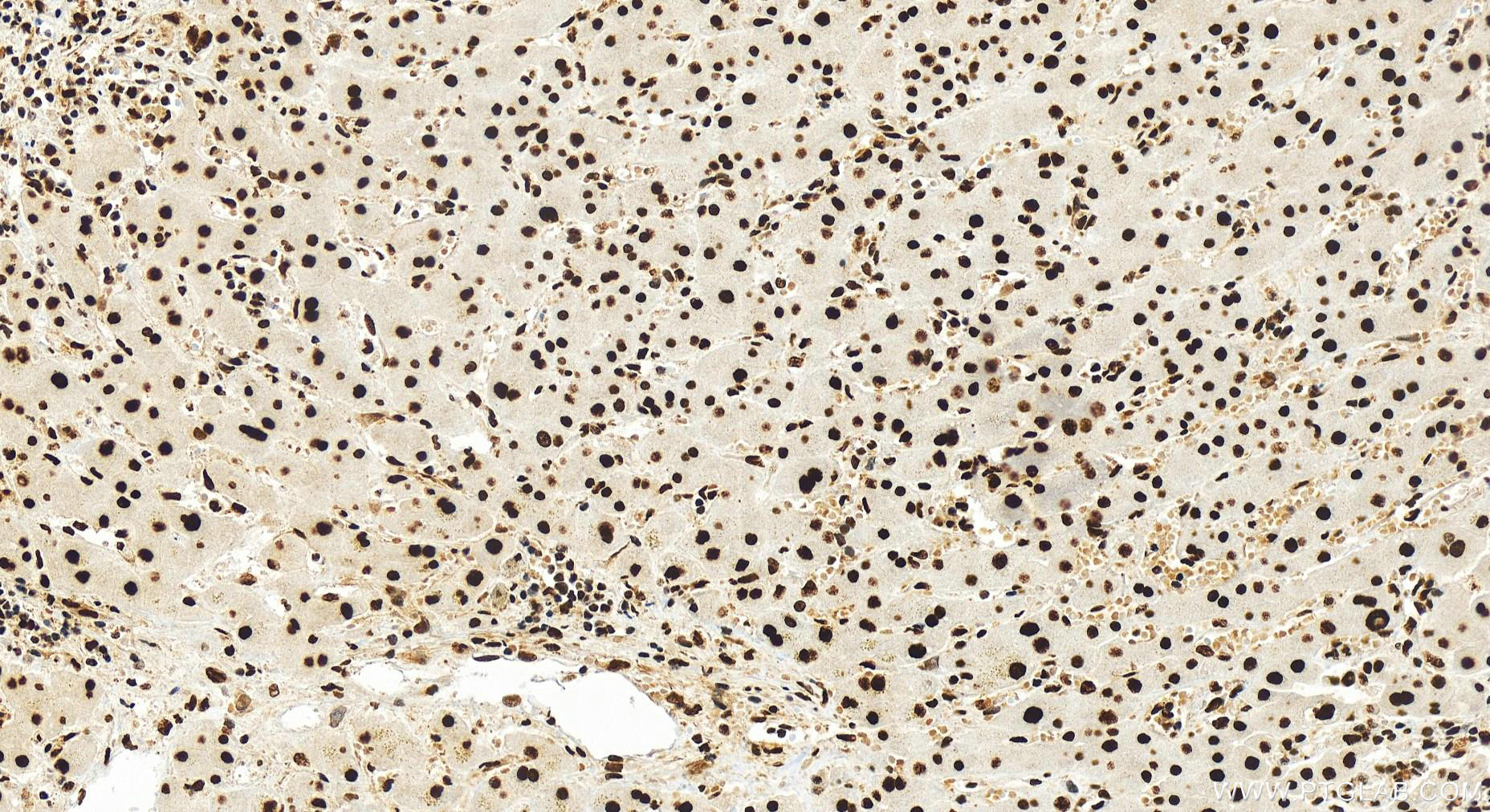 IHC staining of human intrahepatic cholangiocarcinoma using 82898-2-RR (same clone as 82898-2-PBS)