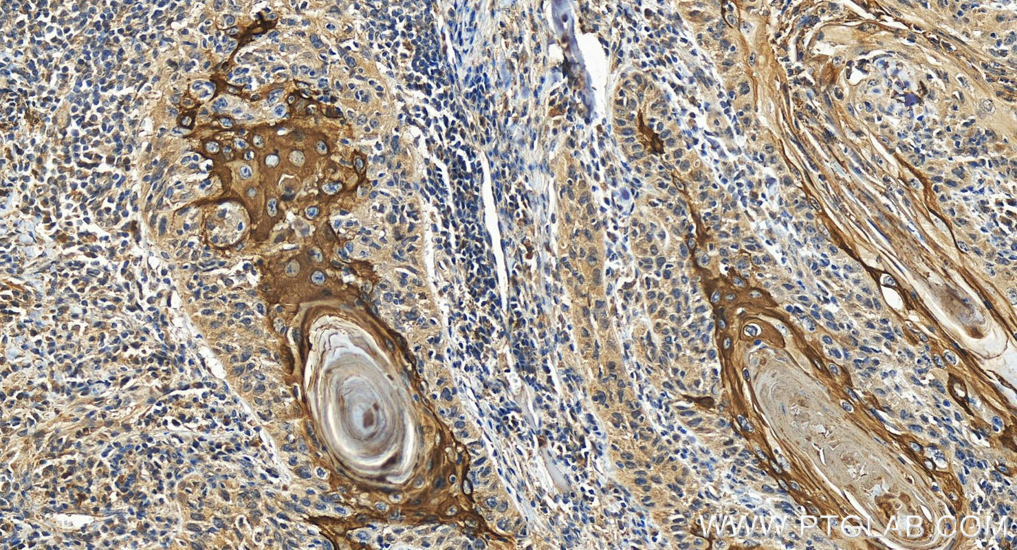 IHC staining of human skin cancer using 16855-1-AP