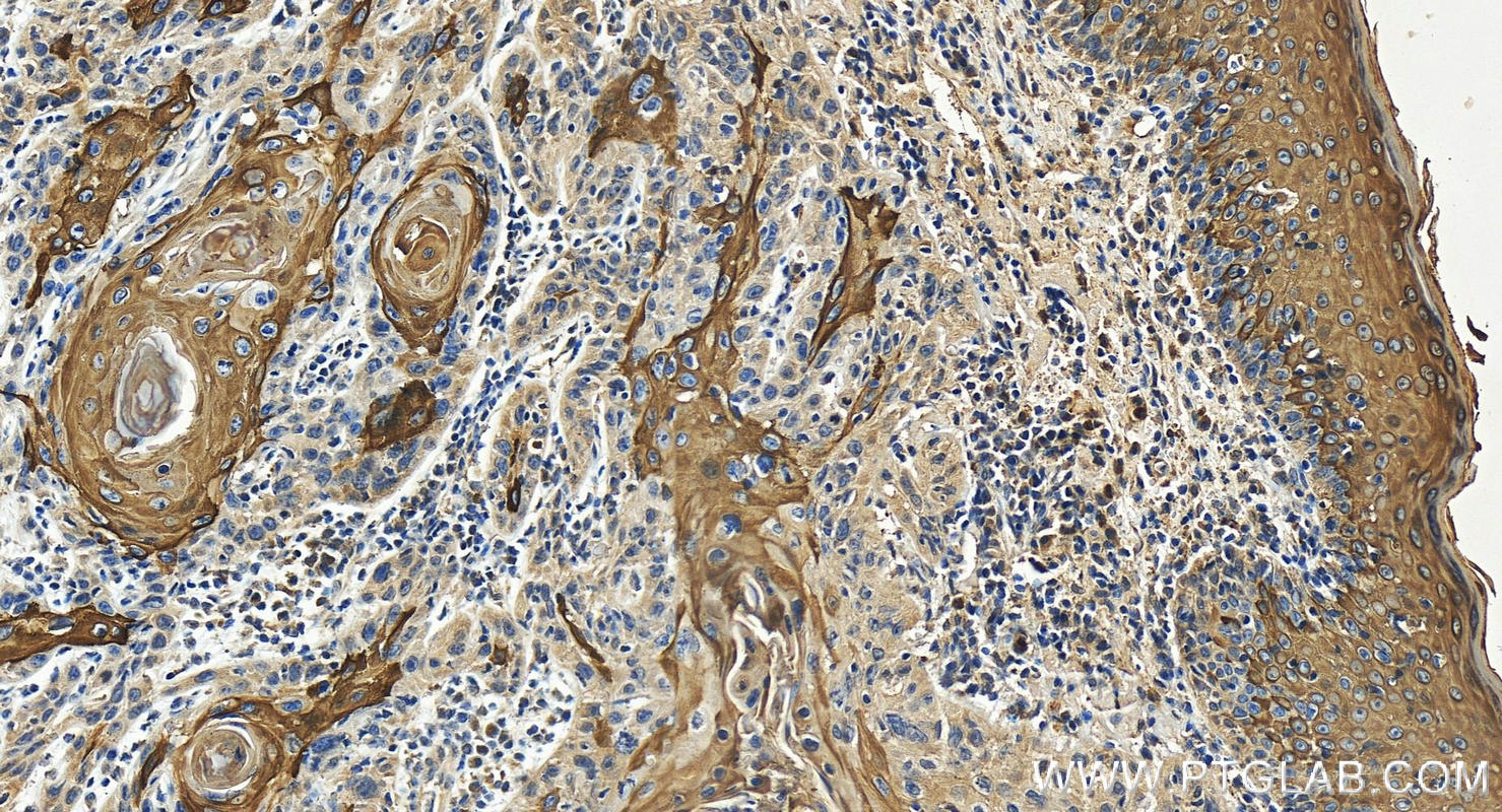 IHC staining of human skin cancer using 16855-1-AP