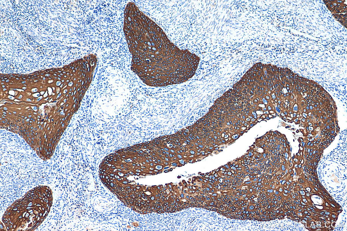 IHC staining of human cervical cancer using 66684-1-Ig