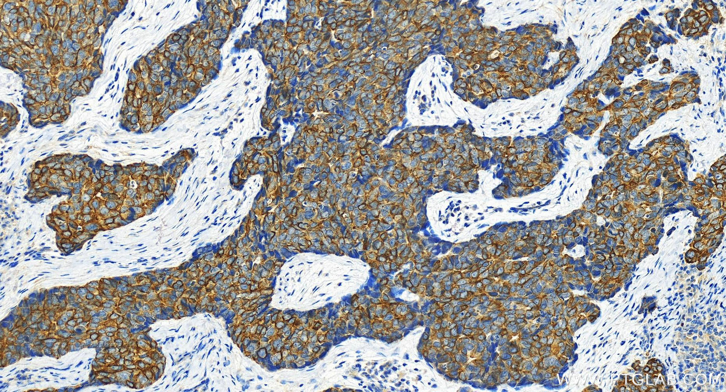 IHC staining of human bowen disease using 22230-1-AP