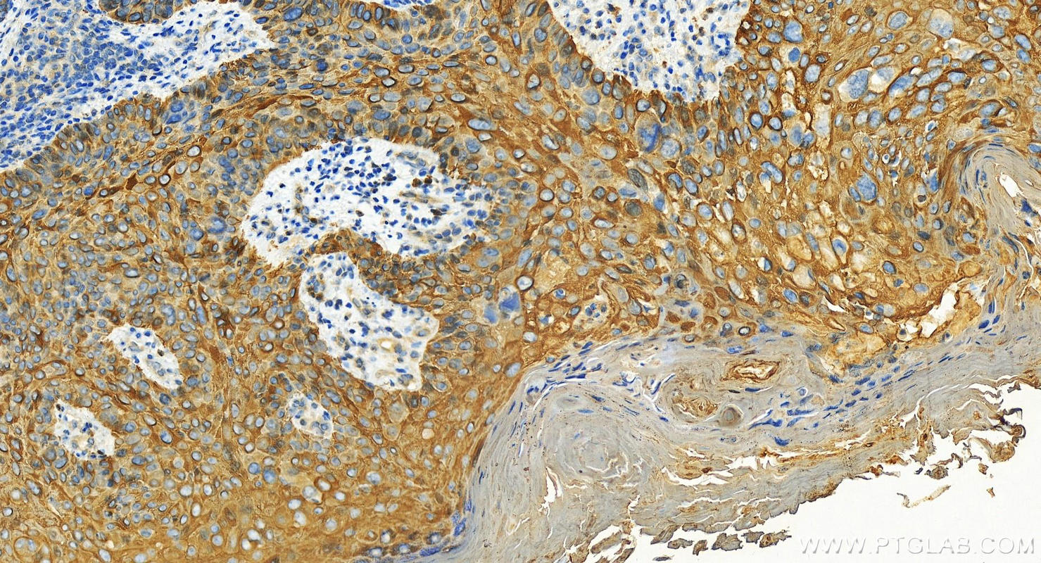 IHC staining of human bowen disease using 22230-1-AP