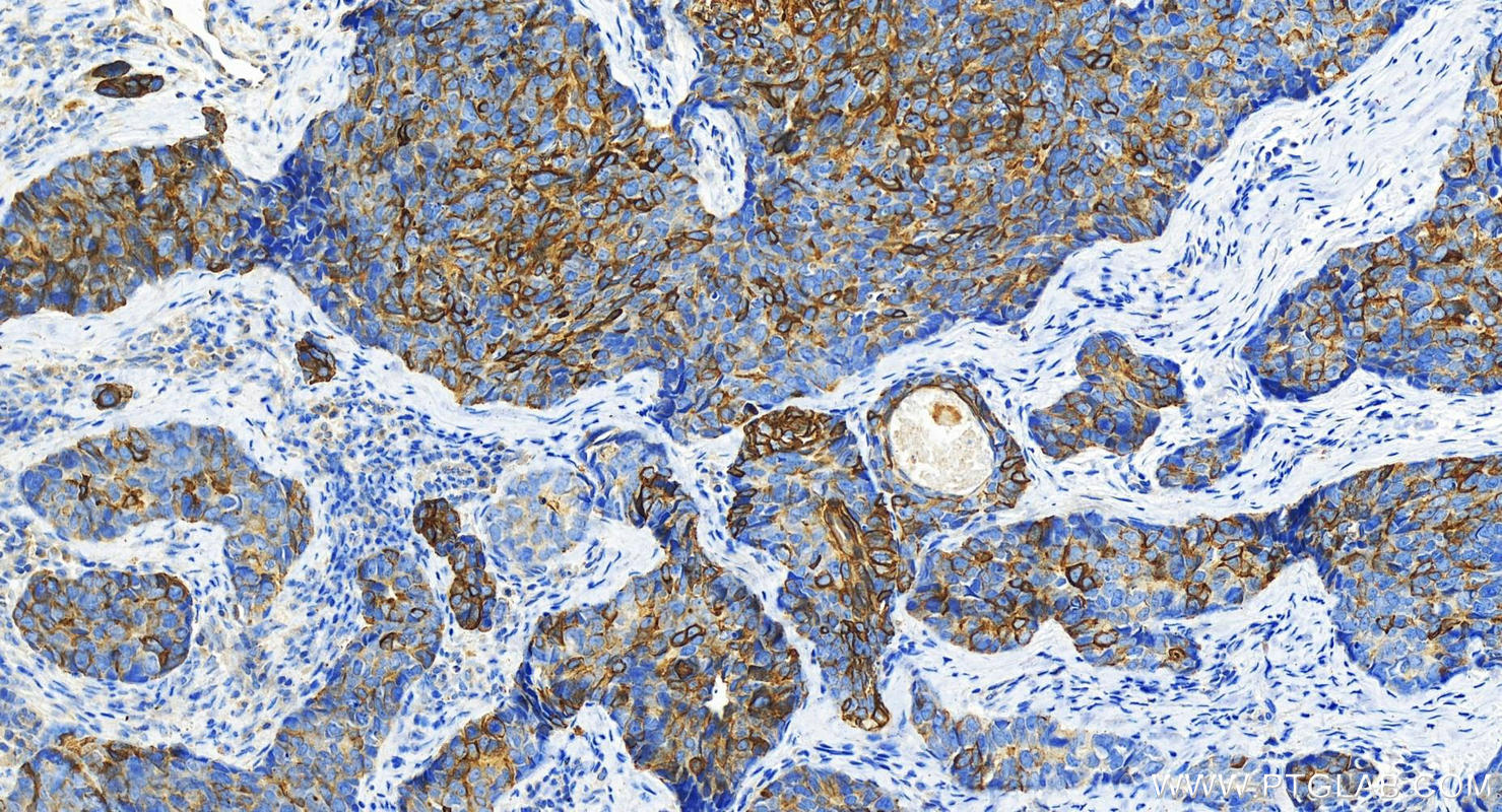 IHC staining of human bowen disease using 17516-1-AP