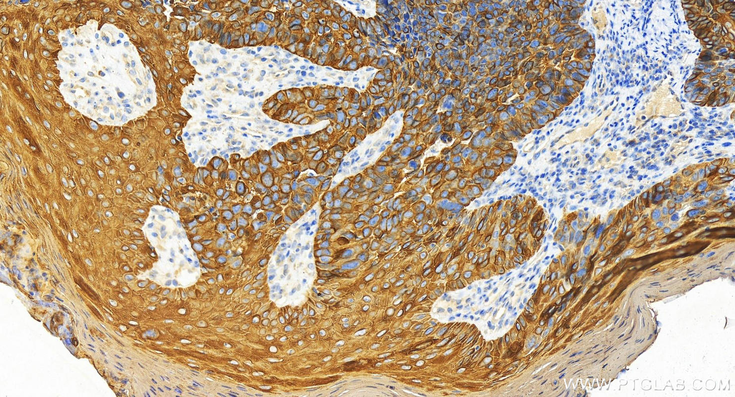 IHC staining of human bowen disease using 17516-1-AP