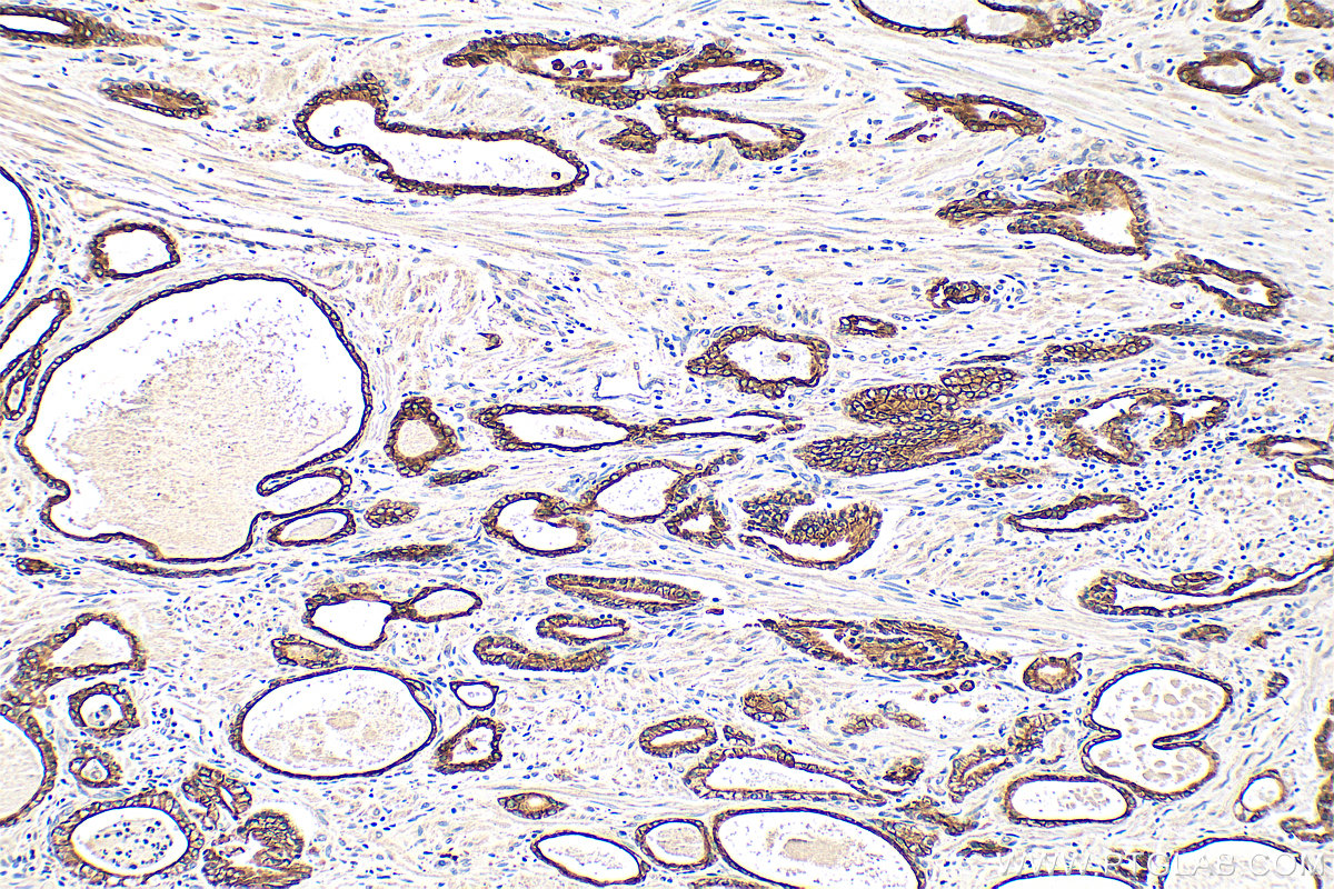 IHC staining of human prostate hyperplasia using 10830-1-AP