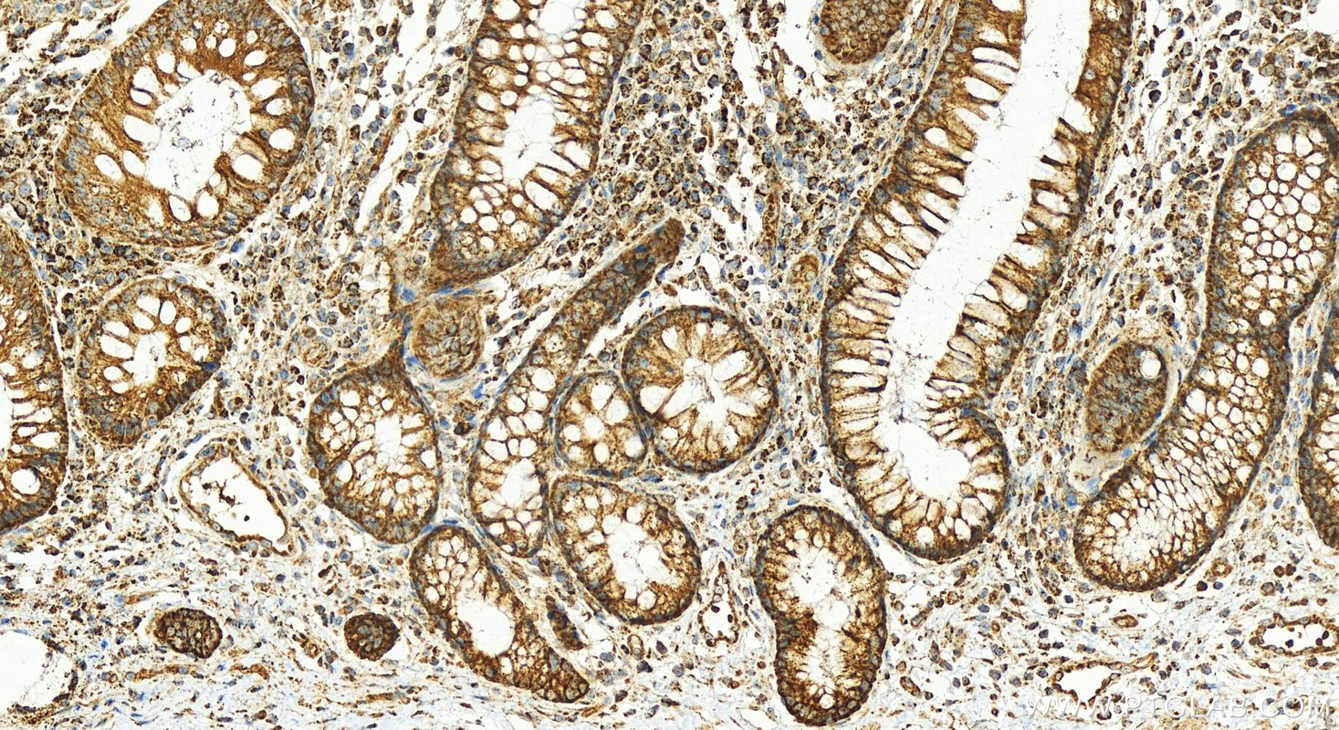 IHC staining of human colon cancer using 18708-1-AP