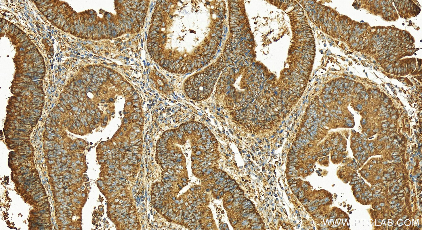 IHC staining of human colon cancer using 18708-1-AP