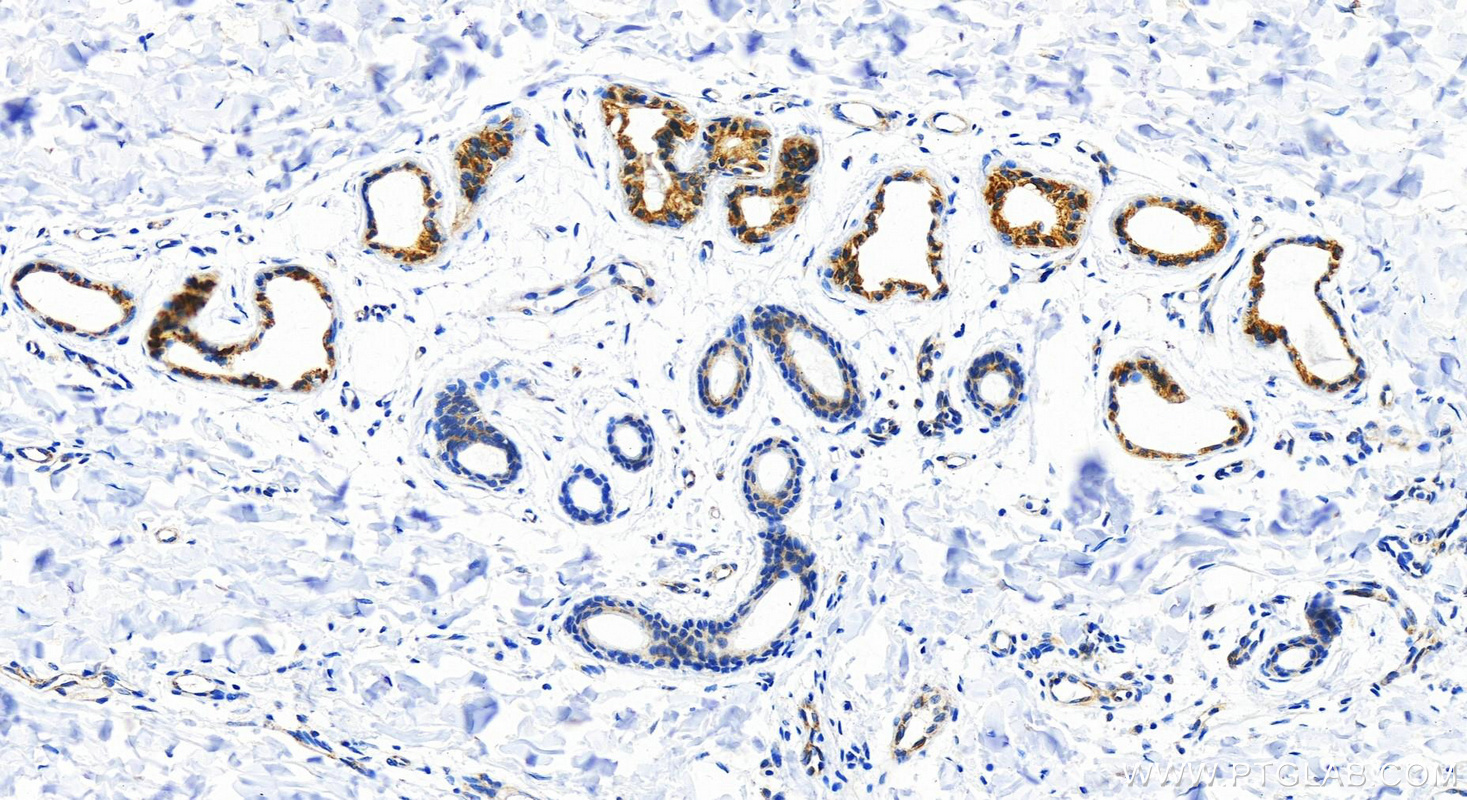 IHC staining of Human bowens disease using 82817-5-RR