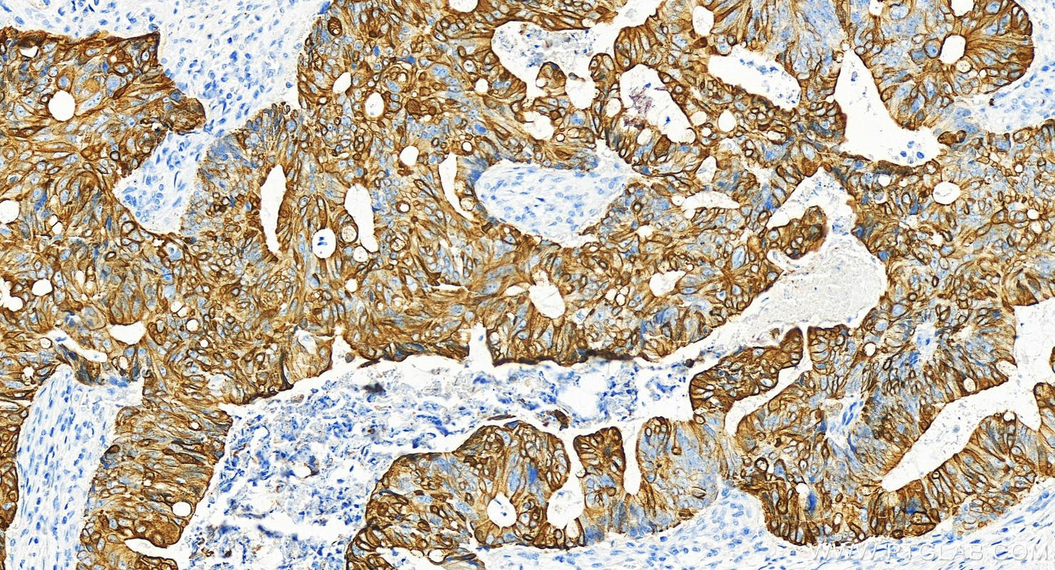 IHC staining of human colon cancer using 82428-1-RR (same clone as 82428-1-PBS)