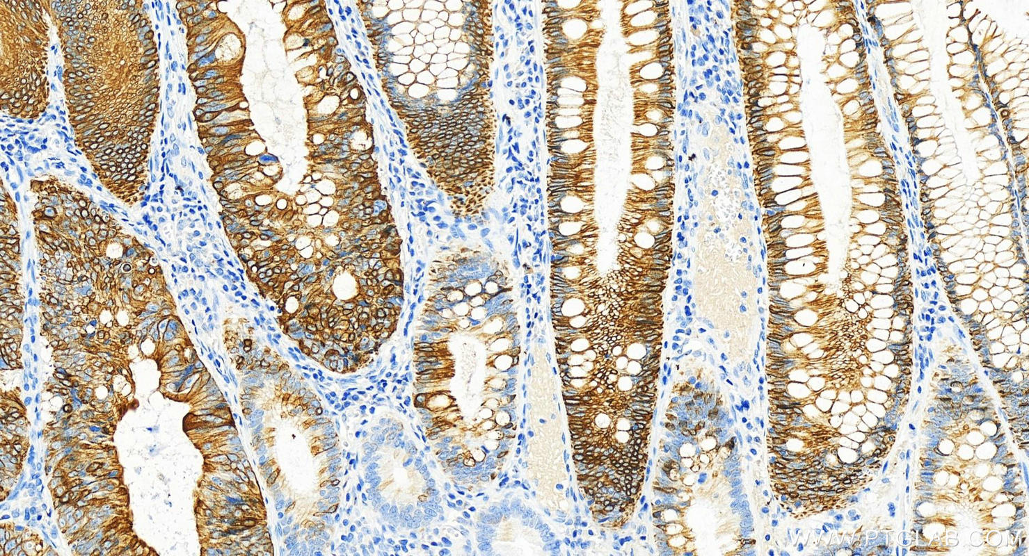 IHC staining of human colon cancer using 82428-1-RR (same clone as 82428-1-PBS)