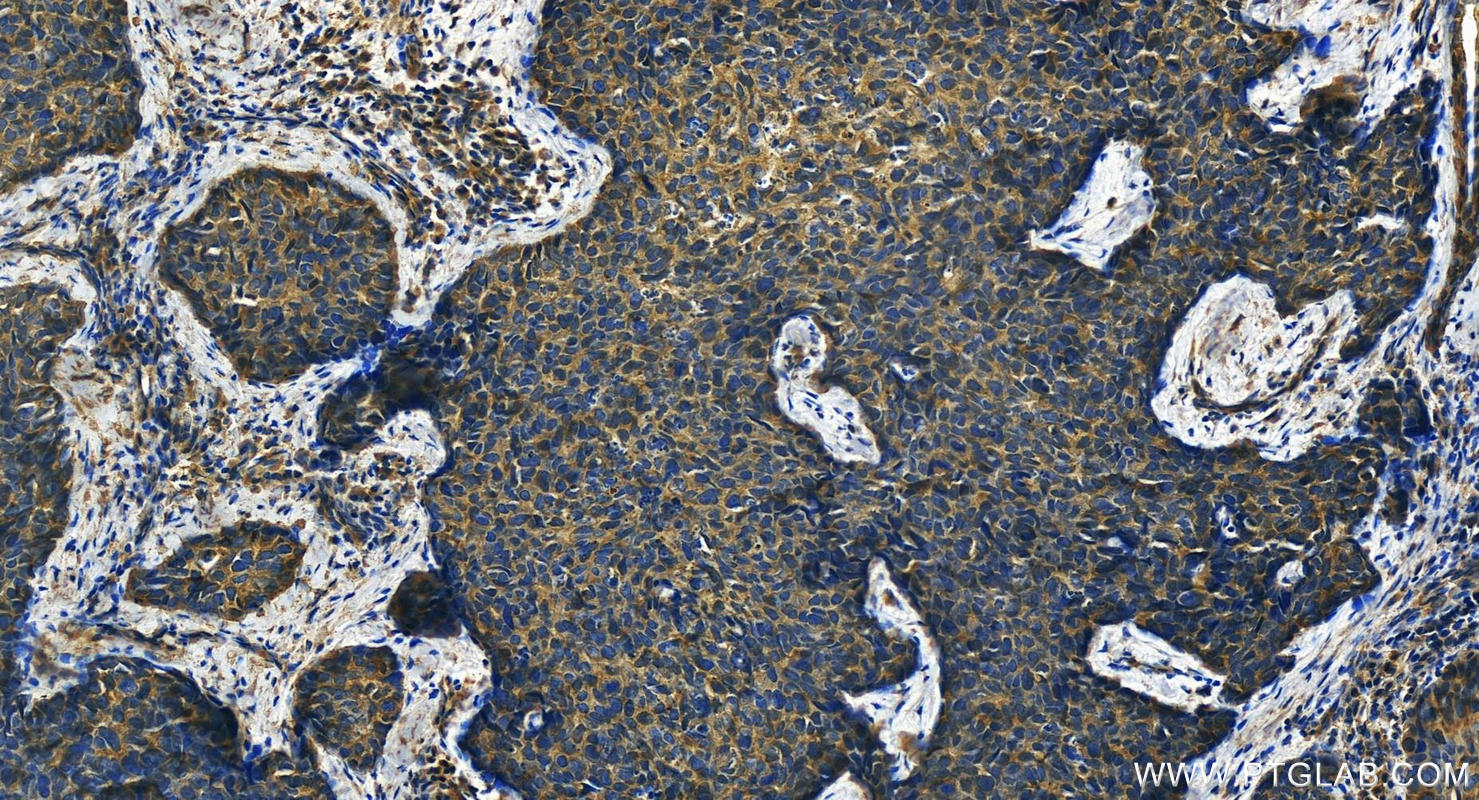 IHC staining of human bowen disease using 24049-1-AP