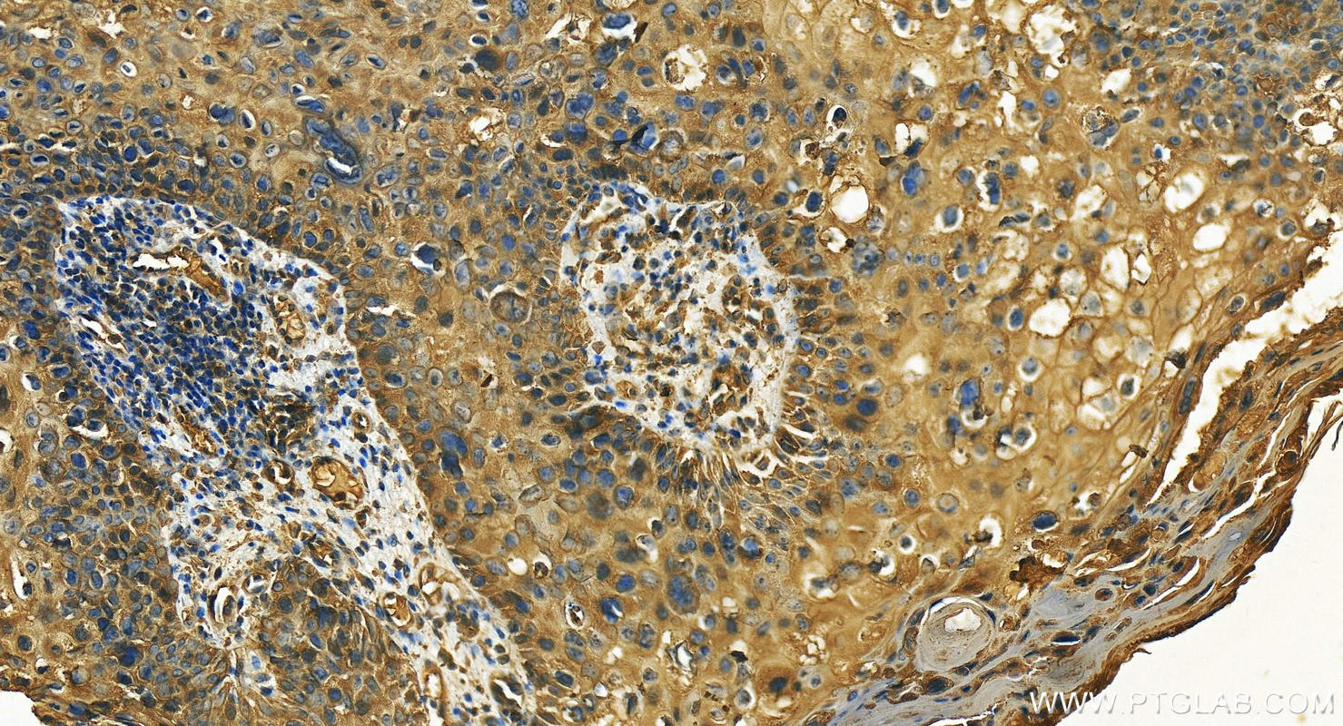 IHC staining of human bowen disease using 24049-1-AP