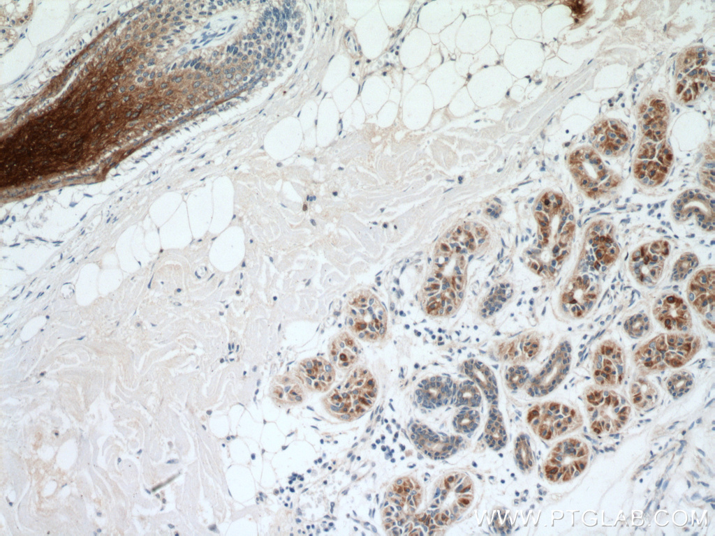 IHC staining of human skin cancer using 20449-1-AP