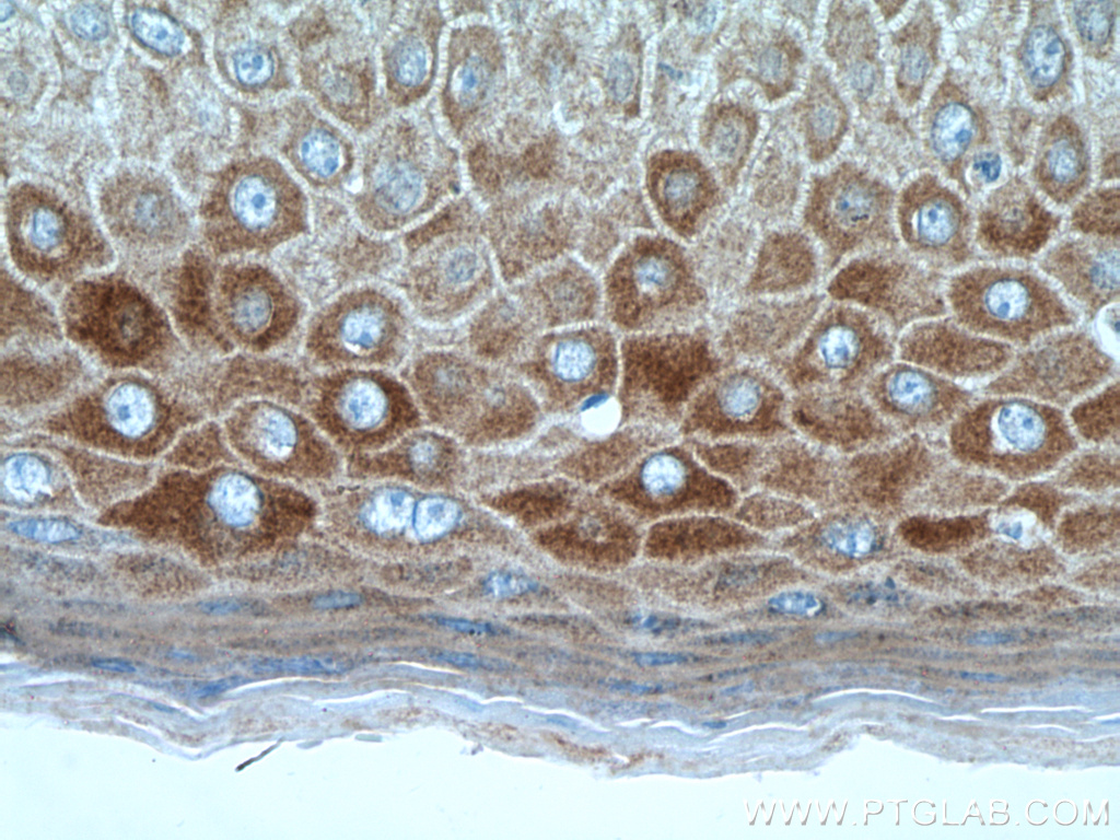 IHC staining of human skin cancer using 20449-1-AP