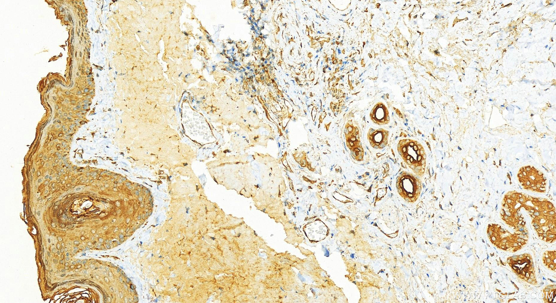 IHC staining of human skin cancer using 16853-1-AP