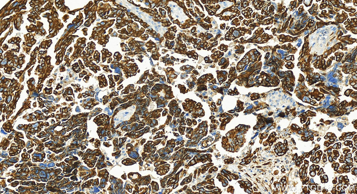 IHC staining of human ovarian cancer using 22208-1-AP