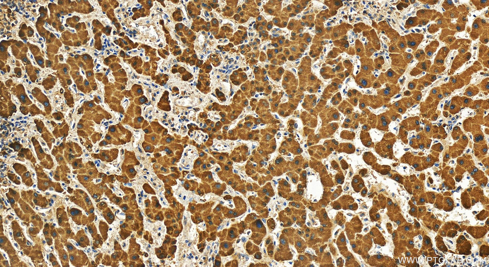 IHC staining of human intrahepatic cholangiocarcinoma using 28237-1-AP