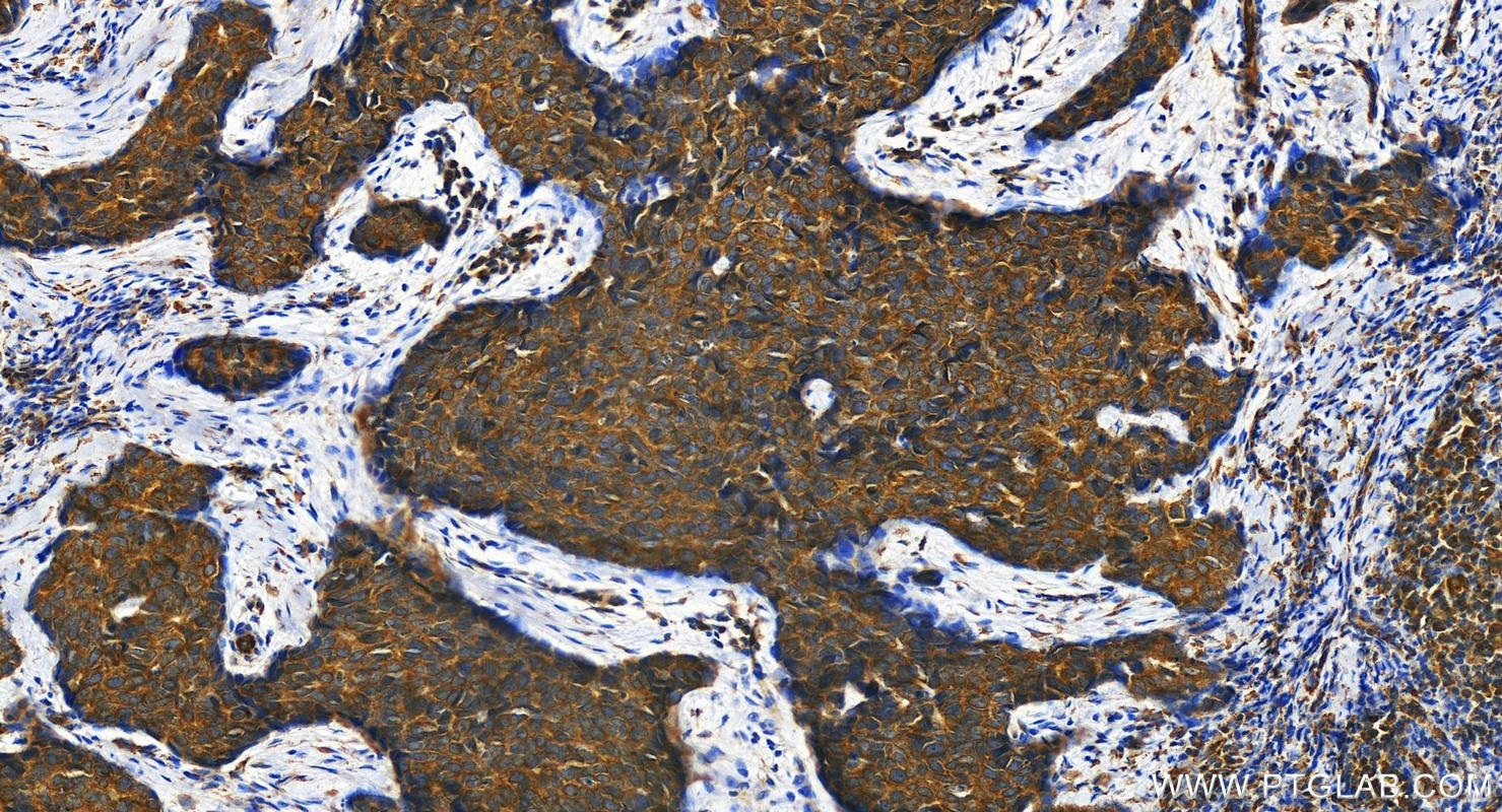 IHC staining of human bowen disease using 19841-1-AP