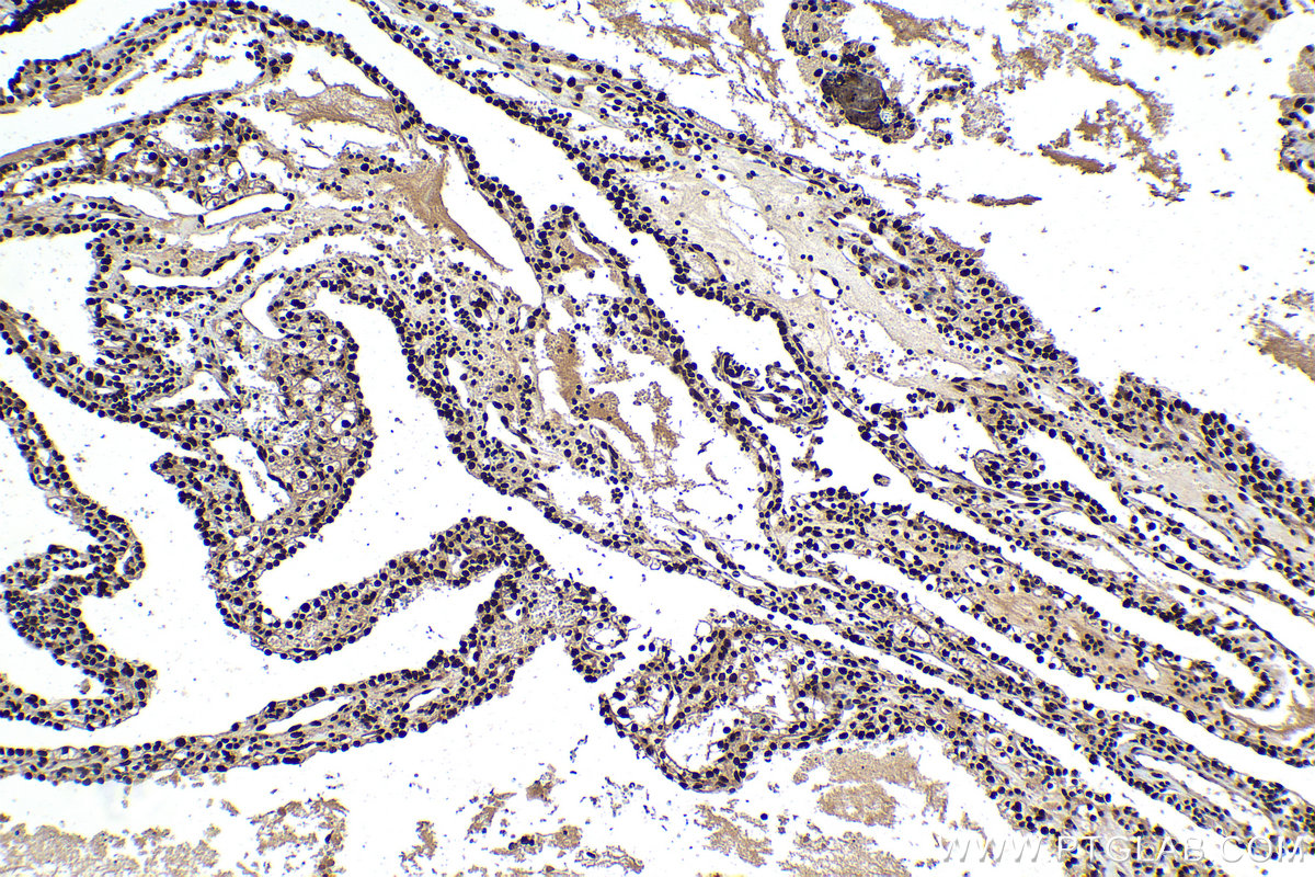 IHC staining of human renal cell carcinoma using 10723-1-AP