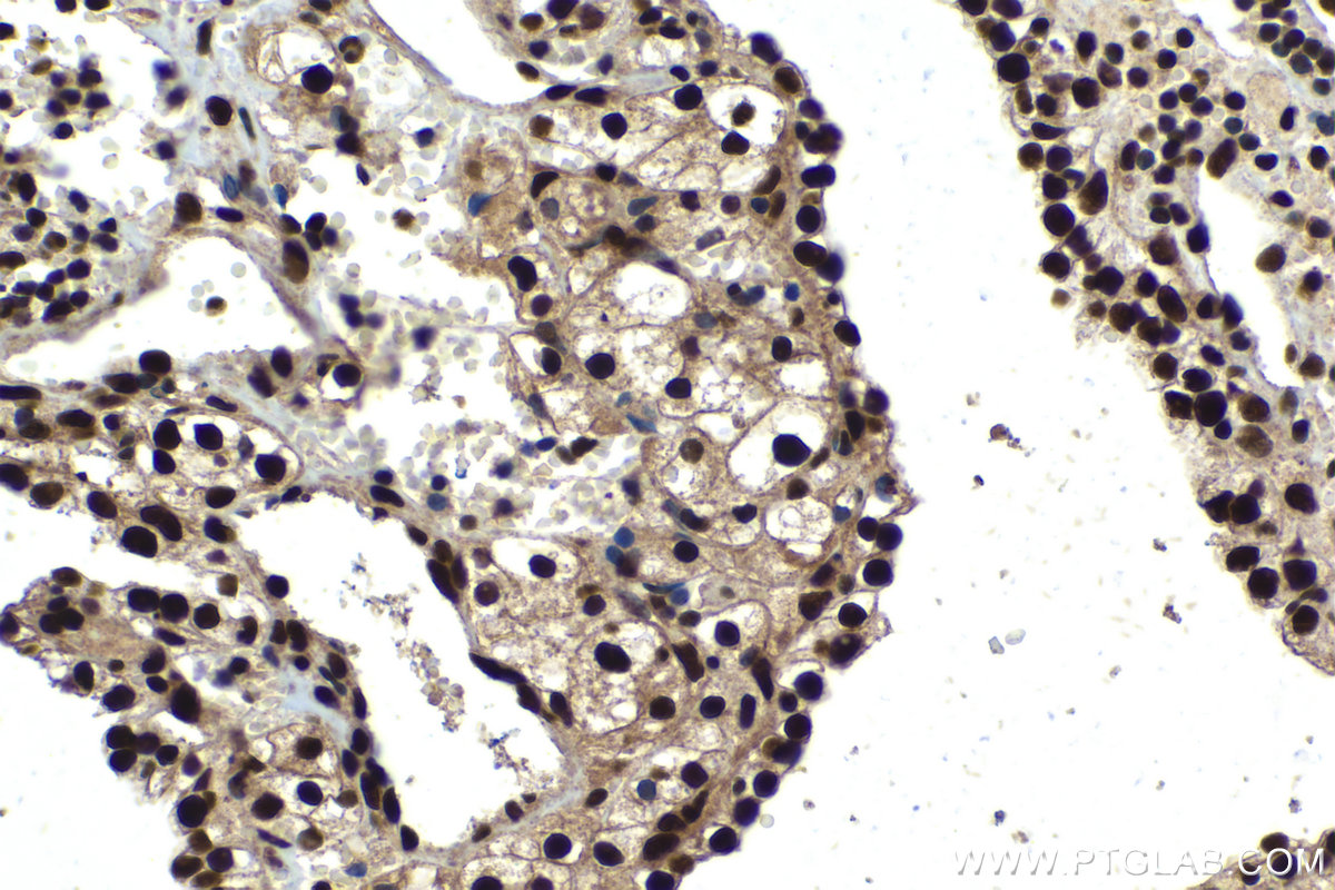 IHC staining of human renal cell carcinoma using 10723-1-AP