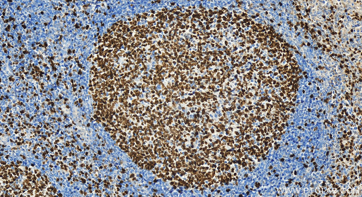 IHC staining of human tonsillitis using 32270-1-AP