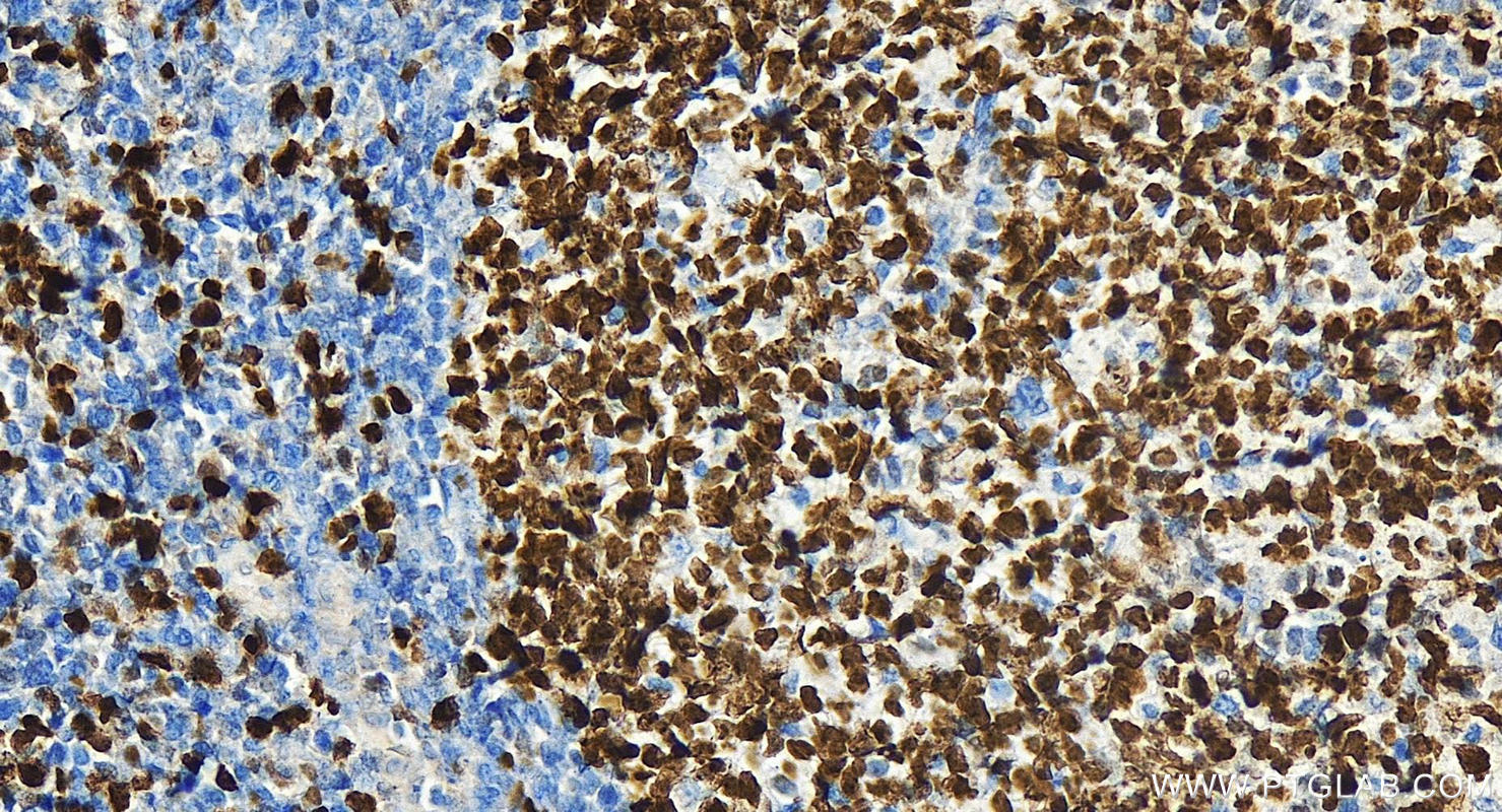 IHC staining of human tonsillitis using 32270-1-AP