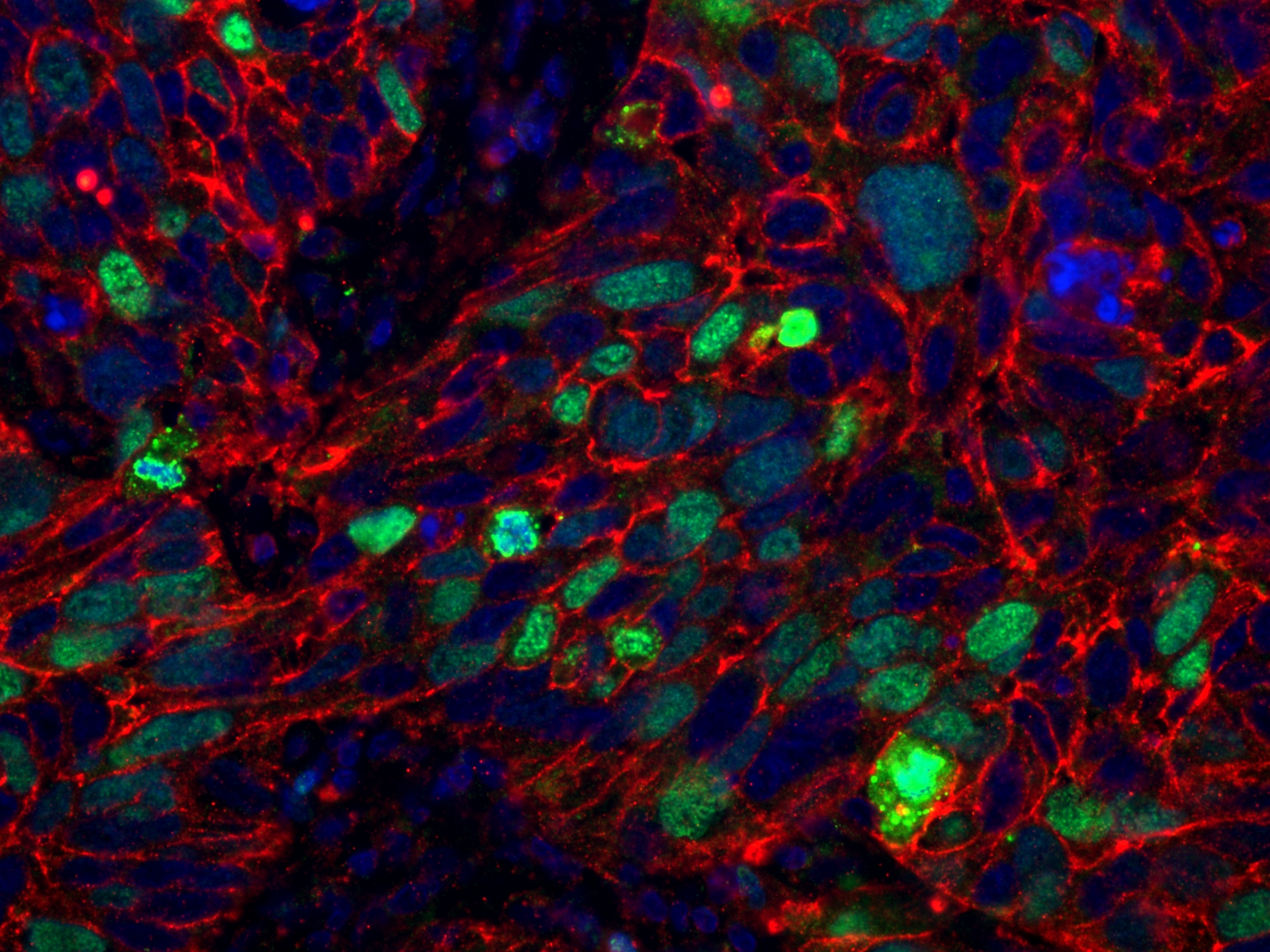 IF Staining of human lung cancer using 84192-4-RR