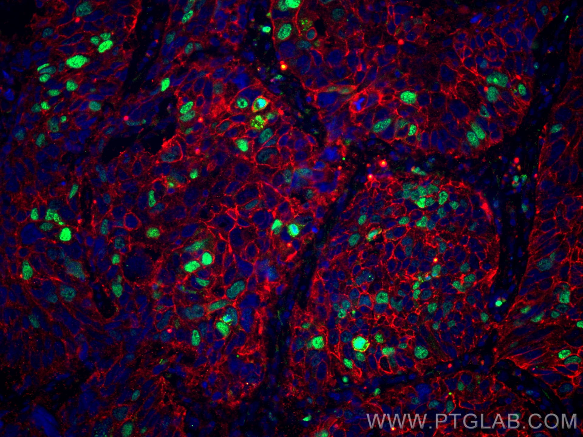 IF Staining of human lung cancer using 84192-4-RR