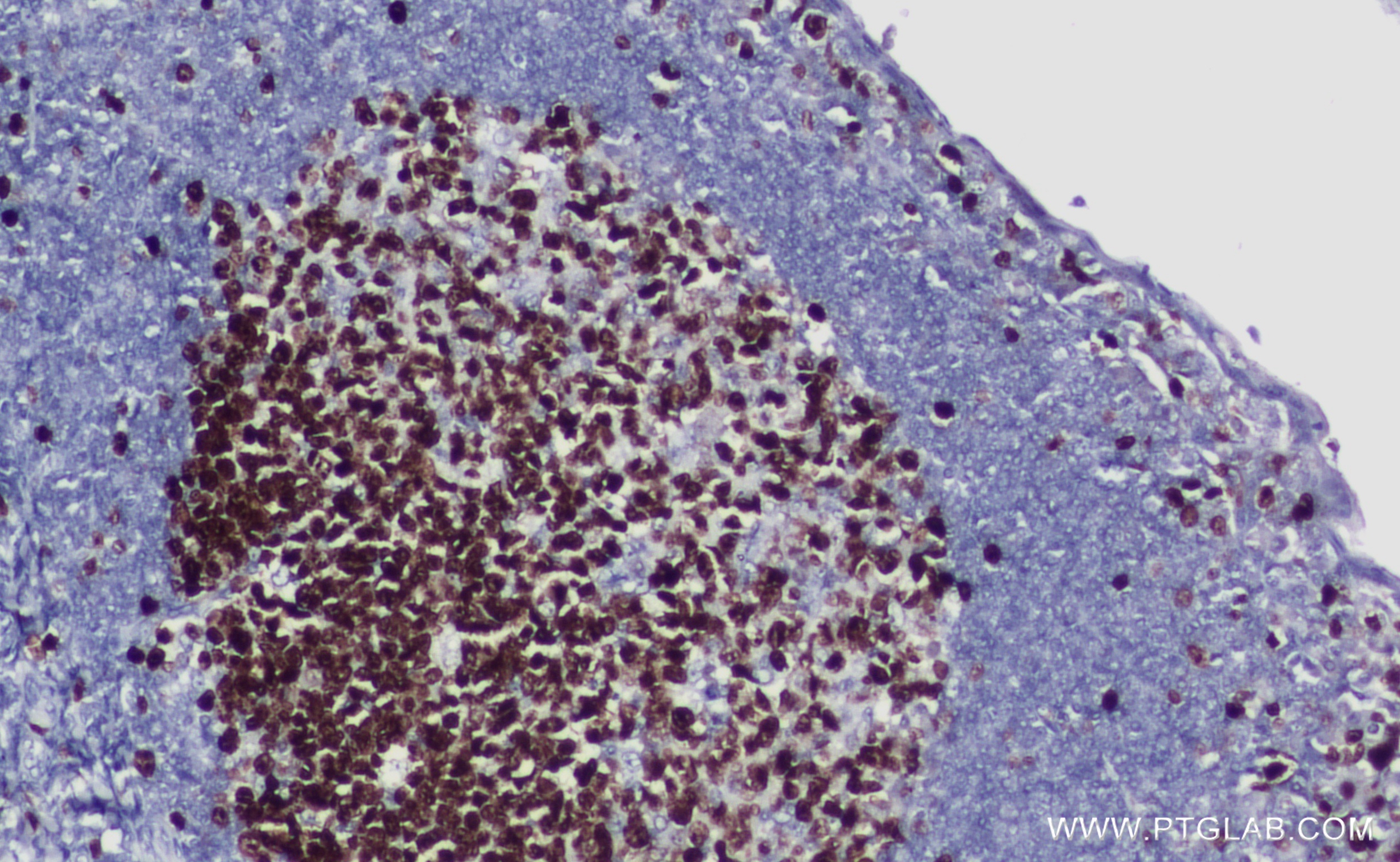 IHC staining of human tonsillitis using 84192-4-RR