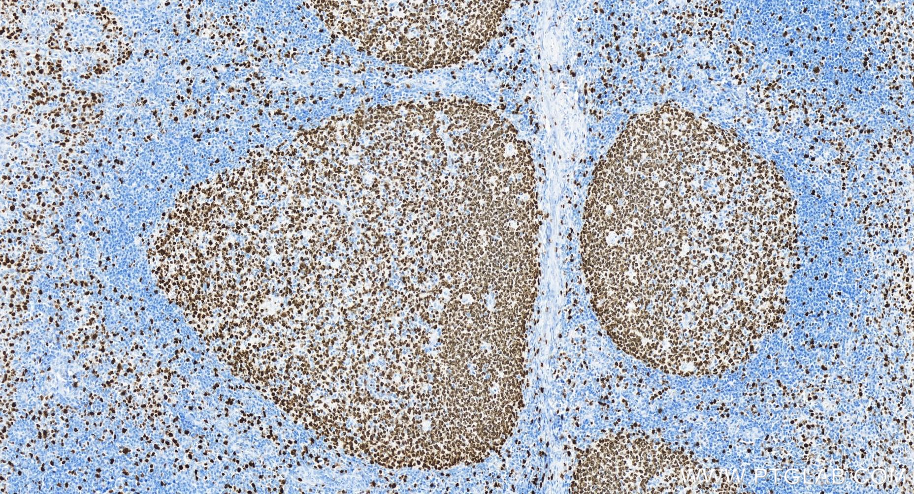 IHC staining of human tonsillitis using 84192-4-RR (same clone as 84192-4-PBS)