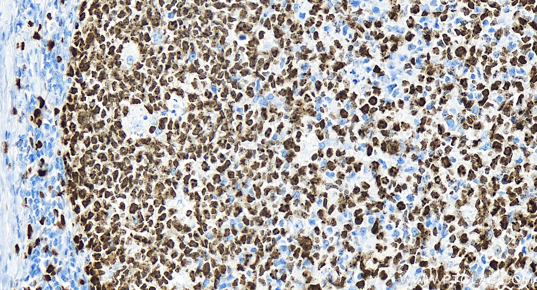 IHC staining of human tonsillitis using 84192-4-RR (same clone as 84192-4-PBS)