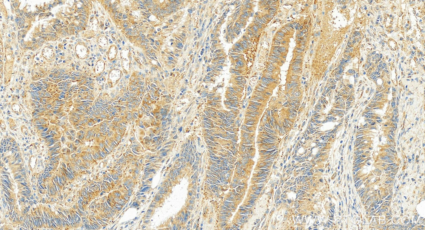 IHC staining of human colon cancer using 67115-1-Ig