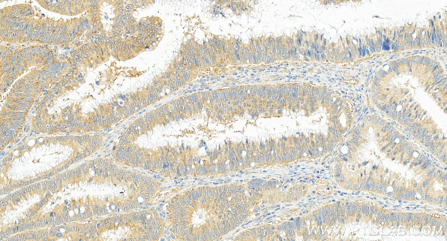 IHC staining of human colon cancer using 67115-1-Ig