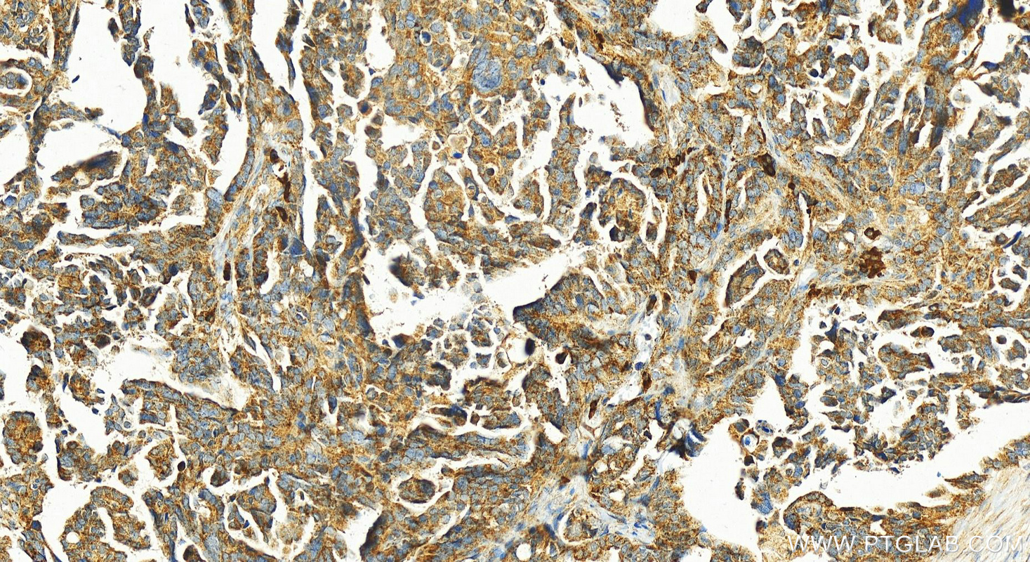 IHC staining of human ovary cancer using 21528-1-AP