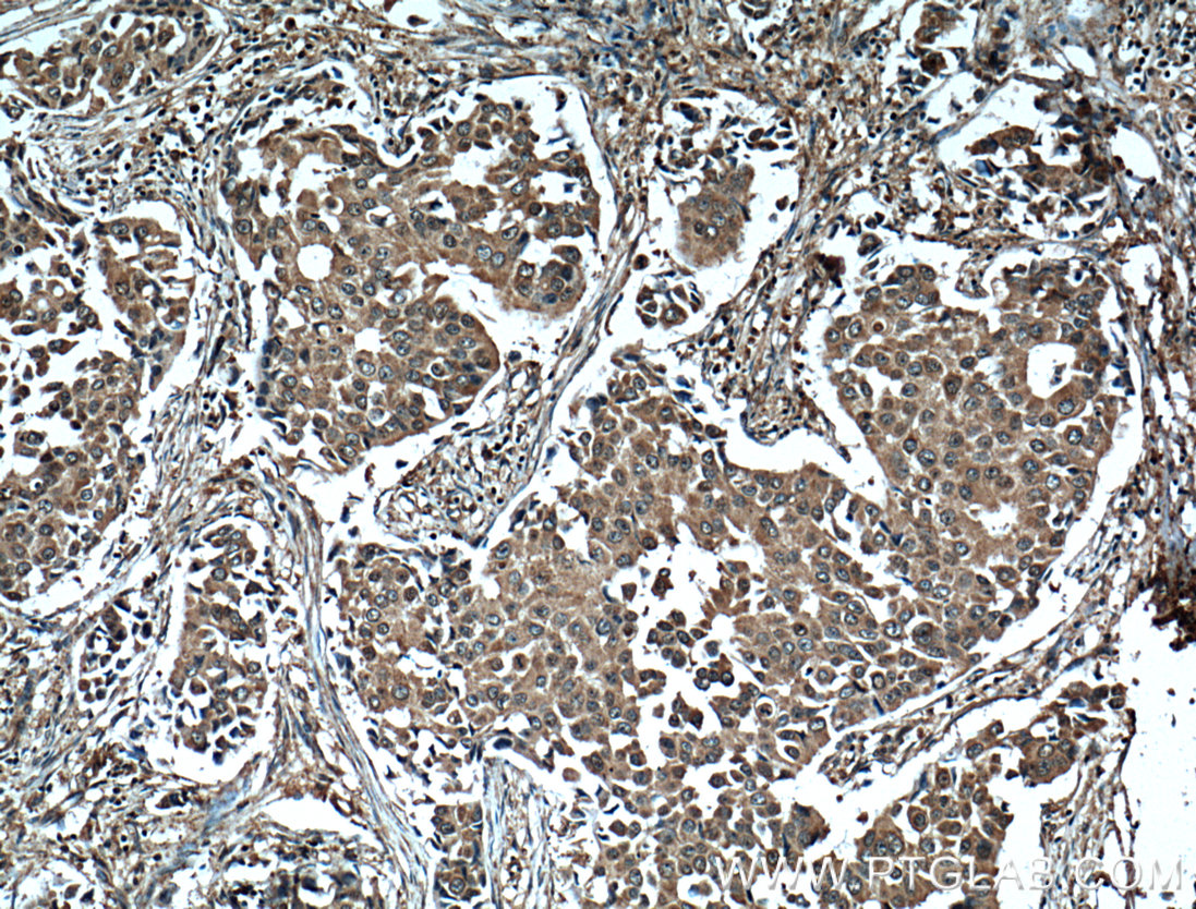 IHC staining of human breast cancer using 66269-1-Ig (same clone as 66269-1-PBS)