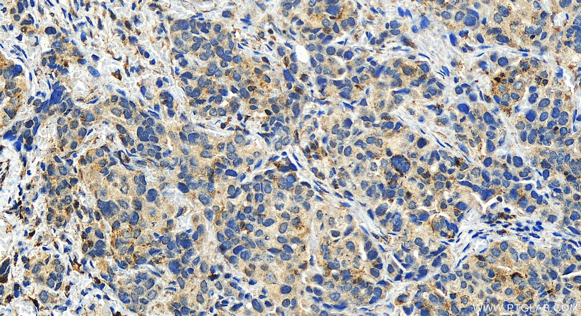 IHC staining of human ovary cancer using 27895-1-AP