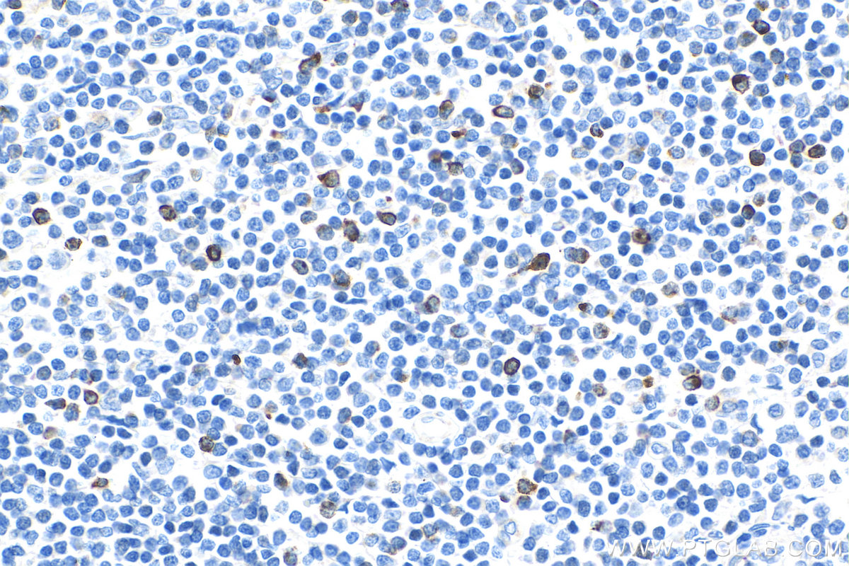 IHC staining of human tonsillitis using 29548-1-AP