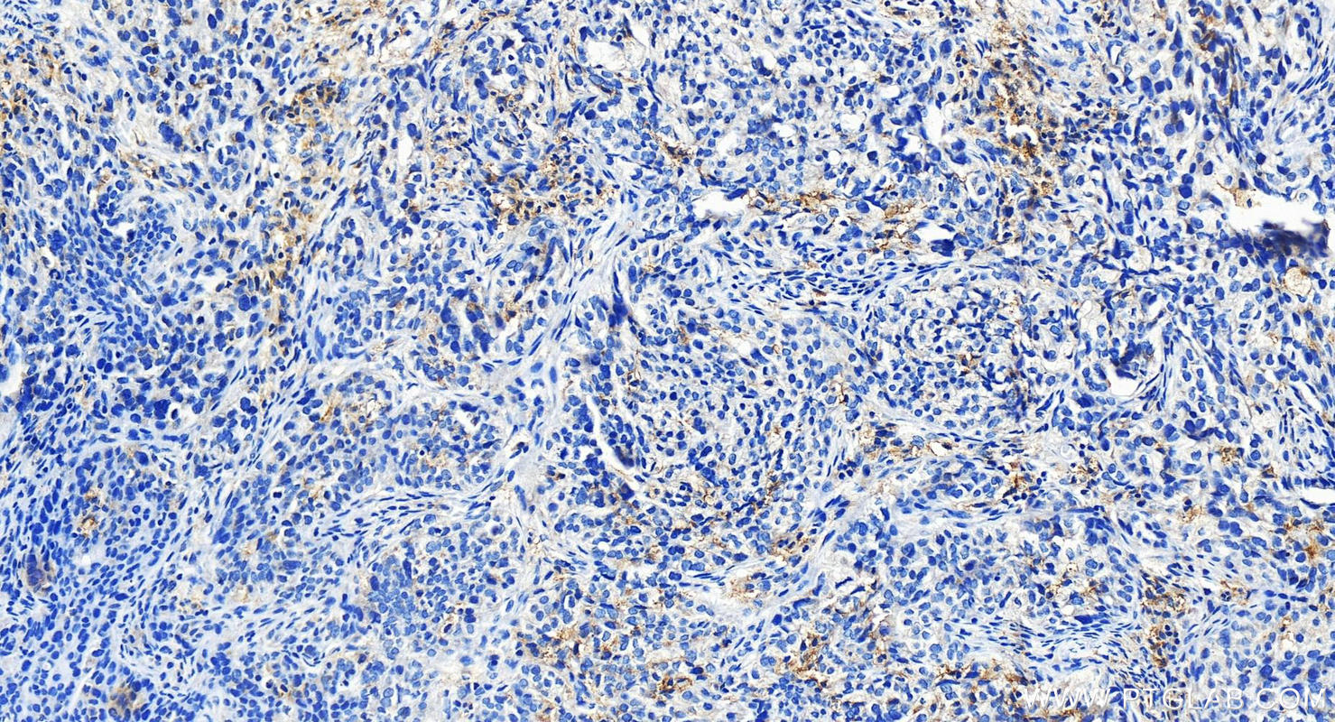 IHC staining of human ovary cancer using 13297-1-AP