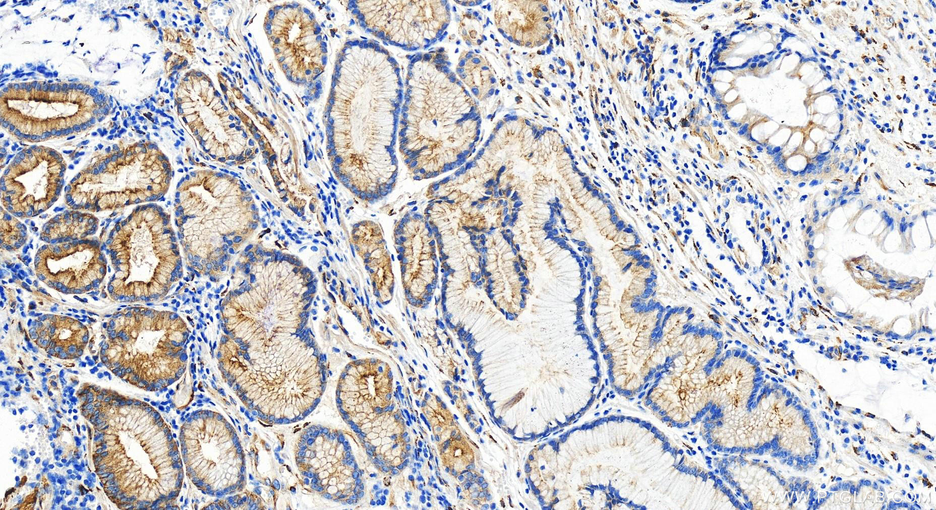 IHC staining of human stomach cancer using 30943-1-AP