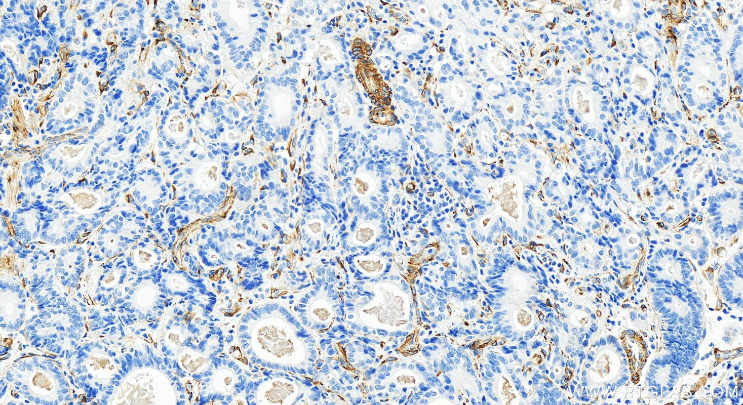 IHC staining of human stomach cancer using 82946-1-RR (same clone as 82946-1-PBS)