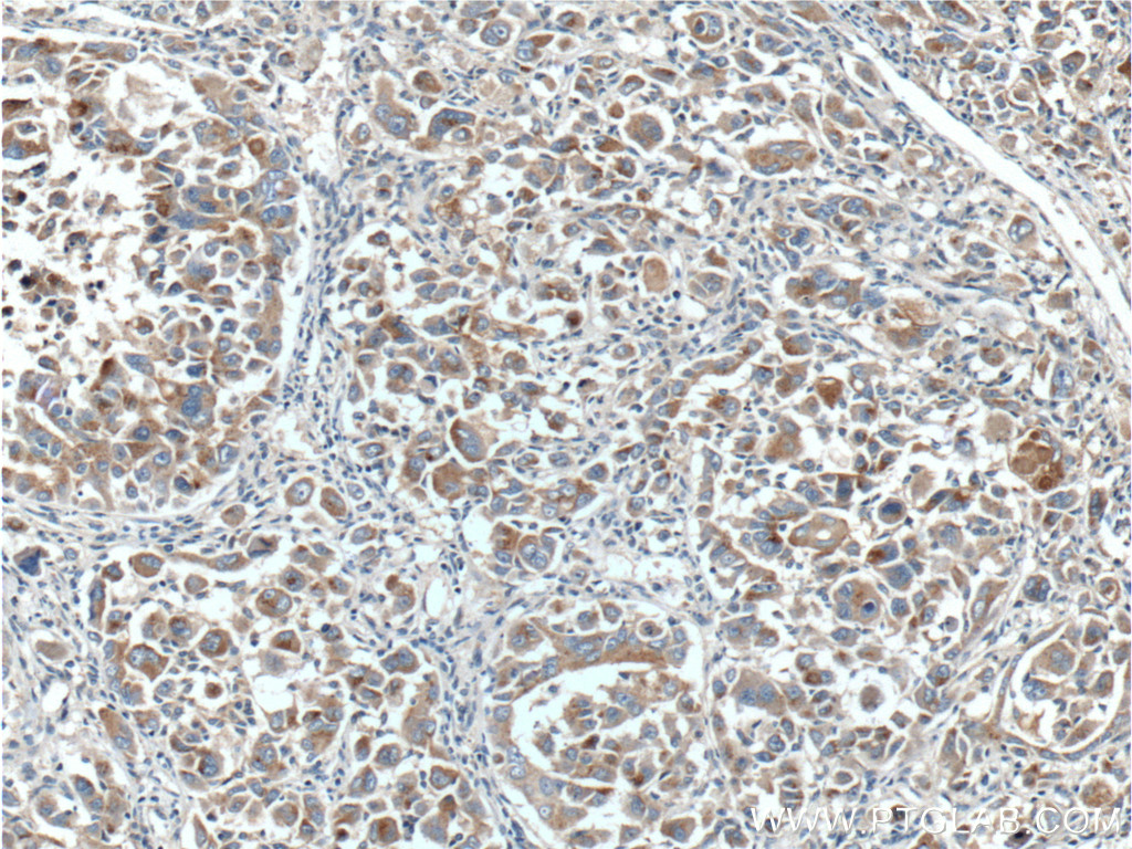 IHC staining of human liver cancer using 18895-1-AP