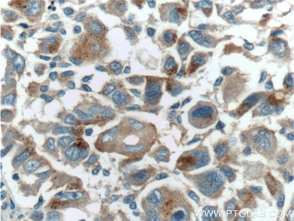 IHC staining of human liver cancer using 18895-1-AP