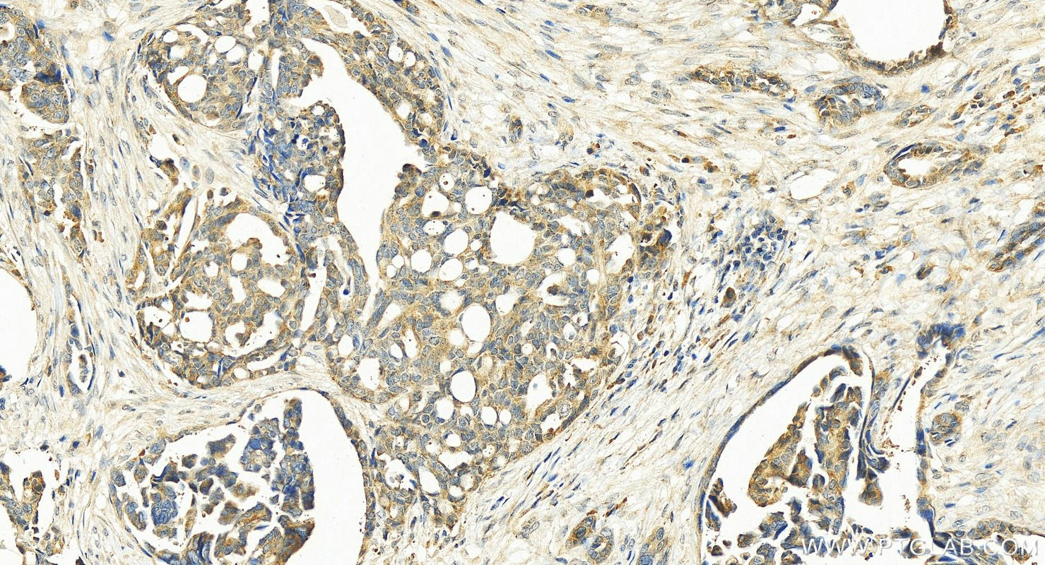 IHC staining of human ovary cancer using 13708-1-AP