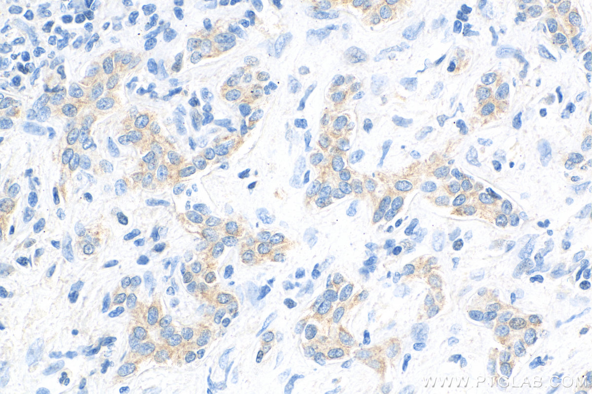 IHC staining of human liver cancer using 68080-1-Ig (same clone as 68080-1-PBS)