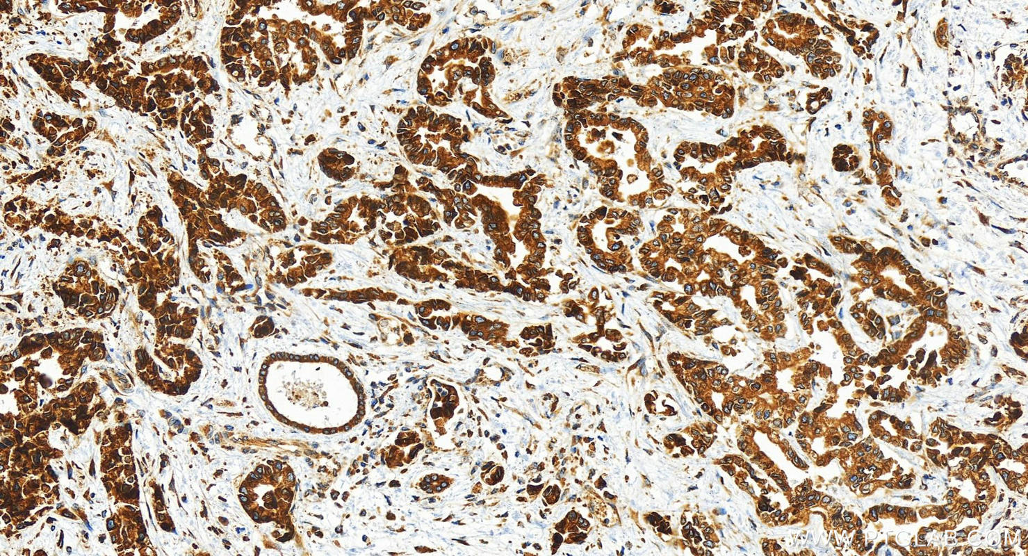 IHC staining of human intrahepatic cholangiocarcinoma using 30183-1-AP