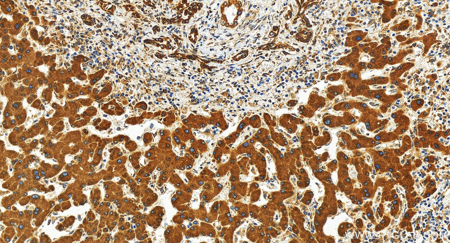 IHC staining of human intrahepatic cholangiocarcinoma using 30183-1-AP