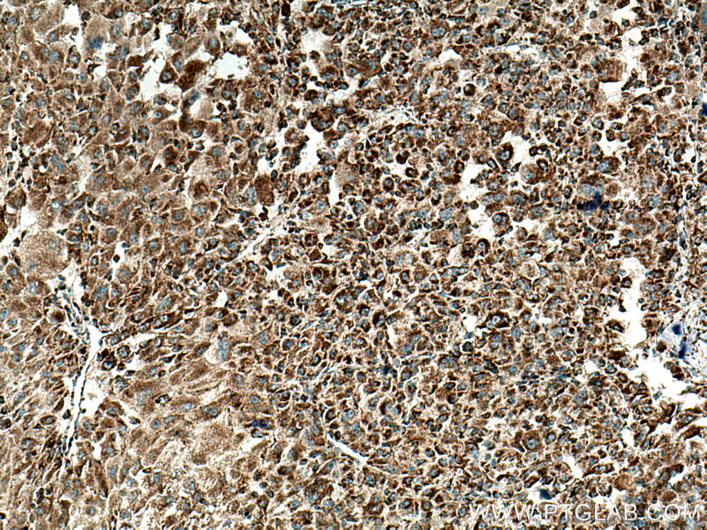 IHC staining of human liver cancer using 20535-1-AP